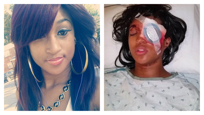 Pregnant Woman Dornella Conners Loses Eye from Ferguson Police Bean Bag Shot