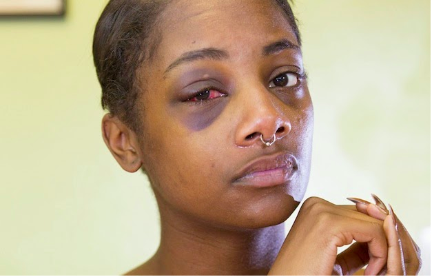 Seattle Officer Who Broke Handcuffed Woman’s Eye Socket Will Not Face Charges